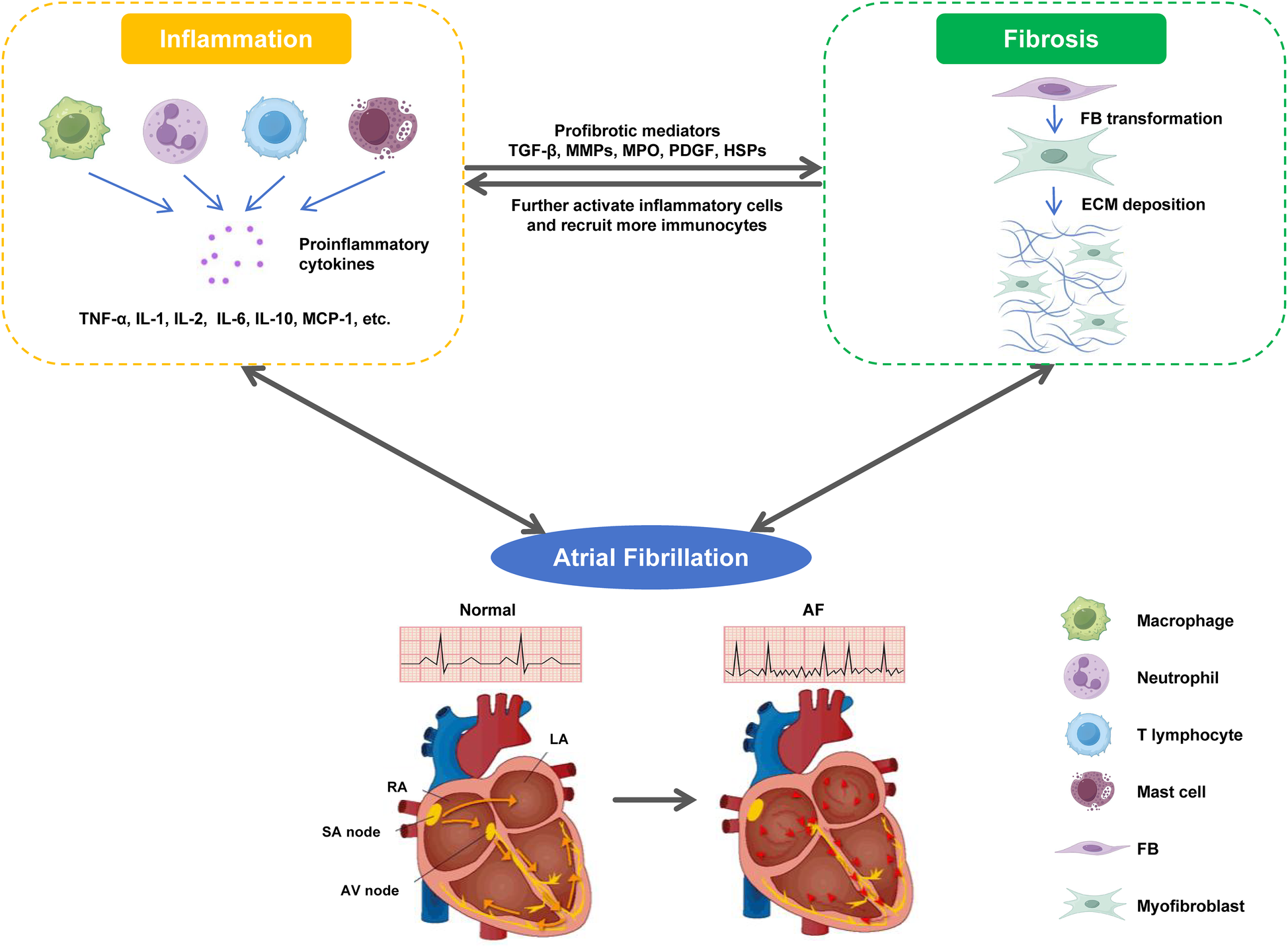 Diagram illustrating the process leading to atrial fibrillation. Inflammation involves macrophages, neutrophils, T lymphocytes, and mast cells releasing proinflammatory cytokines. Fibrosis involves FB transformation and ECM deposition facilitated by profibrotic mediators. Both processes lead to atrial fibrillation, shown by comparing a normal heart rhythm with atrial fibrillation. Key cell types are labeled.