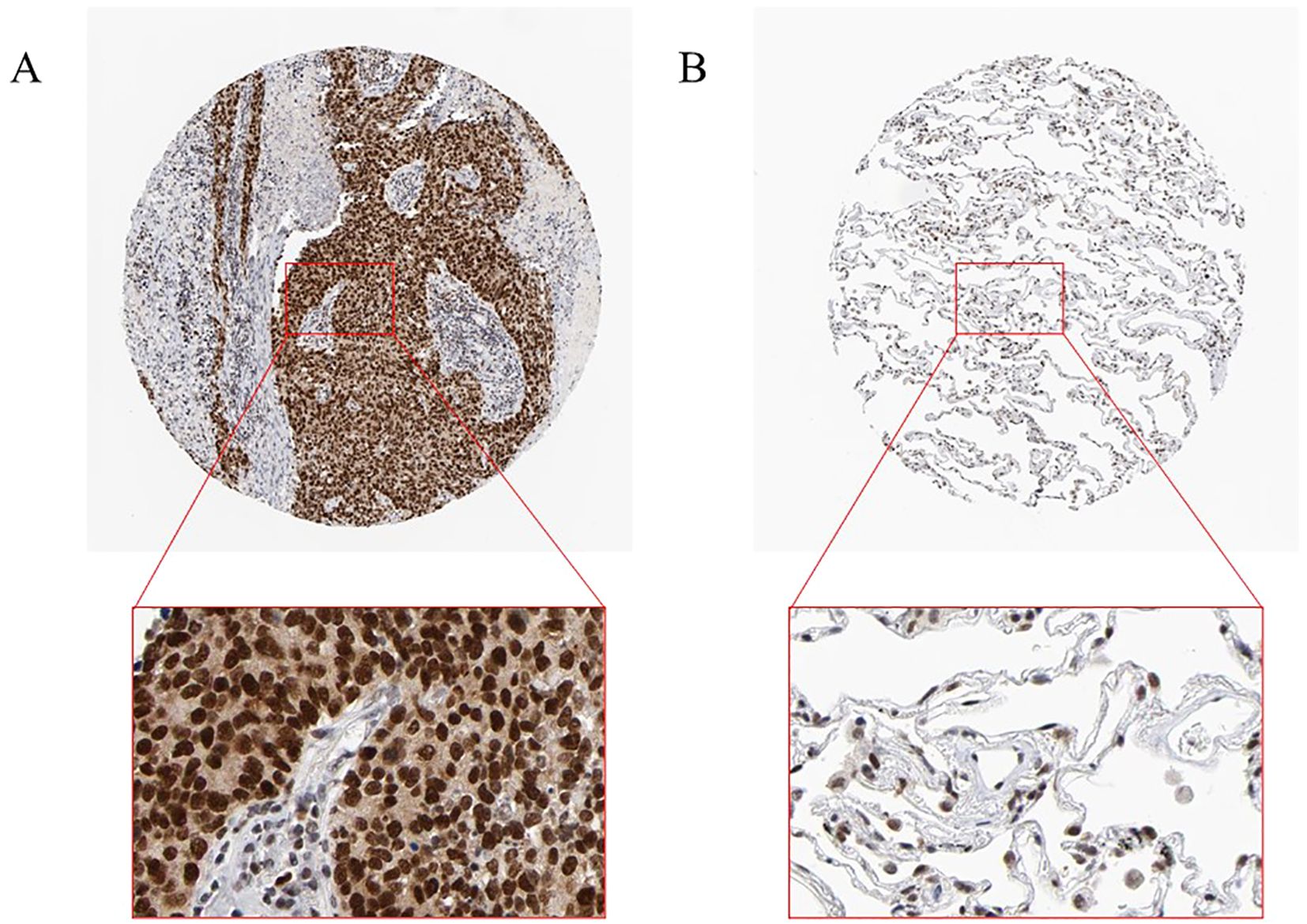 Two circular histological images labeled A and B, each with an enlarged section highlighted in red boxes below. Image A shows densely packed dark-stained cells, while image B shows fewer, lighter-stained cells in a more fibrous structure.