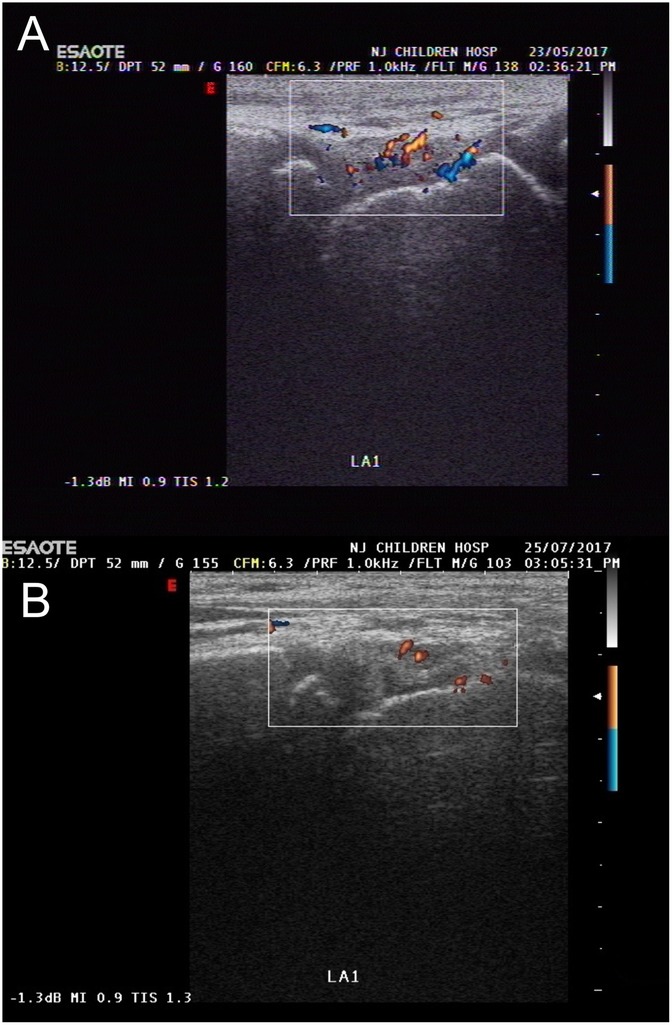 Ultrasound images labeled A and B show color Doppler scans with regions of blood flow highlighted in blue and red. Both images display vascular structures in a rectangular frame. Image A is dated May 23, 2017, and Image B is dated July 25, 2017, both from NJ Children Hospital.