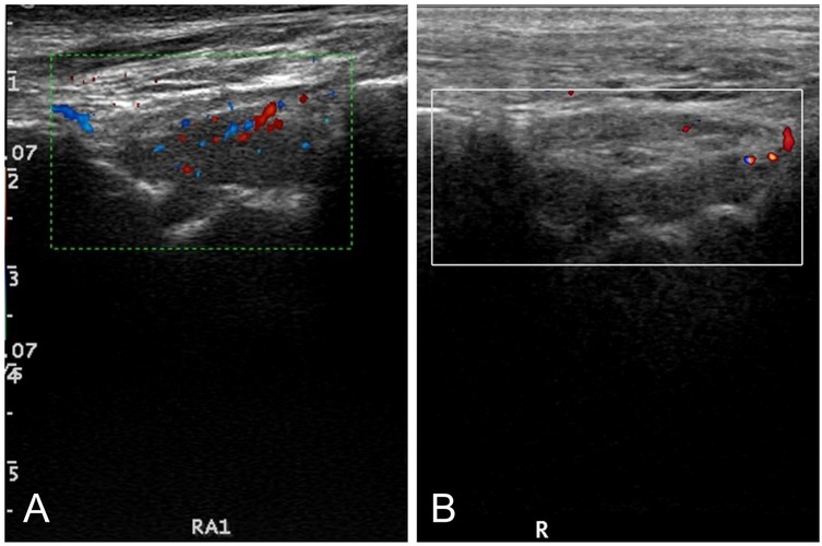 Ultrasound images labeled A and B comparing blood flow. Image A shows color Doppler signals with red indicating blood flow towards the probe and blue indicating flow away, within a green-dotted box. Image B has minimal color signals within a white box.