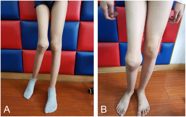 Two images labeled A and B comparing legs against a red and blue padded wall backdrop. Image A shows thin legs with socks, while image B shows thicker legs with bare feet.