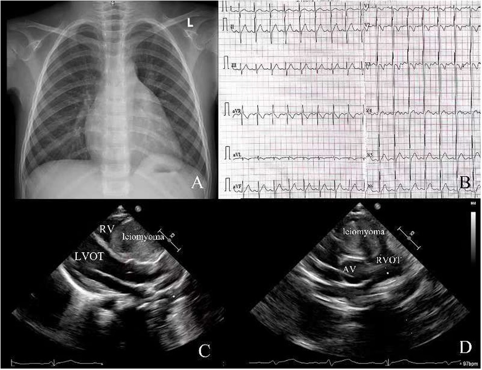 A composite medical image includes four panels: (A) a chest X-ray showing the lungs and heart, (B) an electrocardiogram with heart rhythm tracings, (C) an ultrasound indicating a mass labeled \