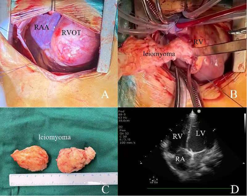 Panel A shows an open chest with labels RAA and RVOT on the heart. Panel B depicts the extraction of a leiomyoma from the heart area. Panel C displays two leiomyomas on a green cloth with a ruler indicating size. Panel D is an ultrasound image of the heart labeled RV, LV, and RA.