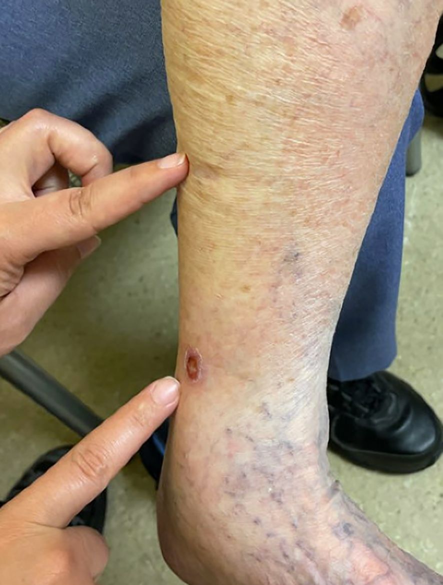 A close-up of a person's leg showing a small, circular sore on the skin. Two hands are pointing at the sore, highlighting the area of interest. The leg skin appears slightly discolored and textured.