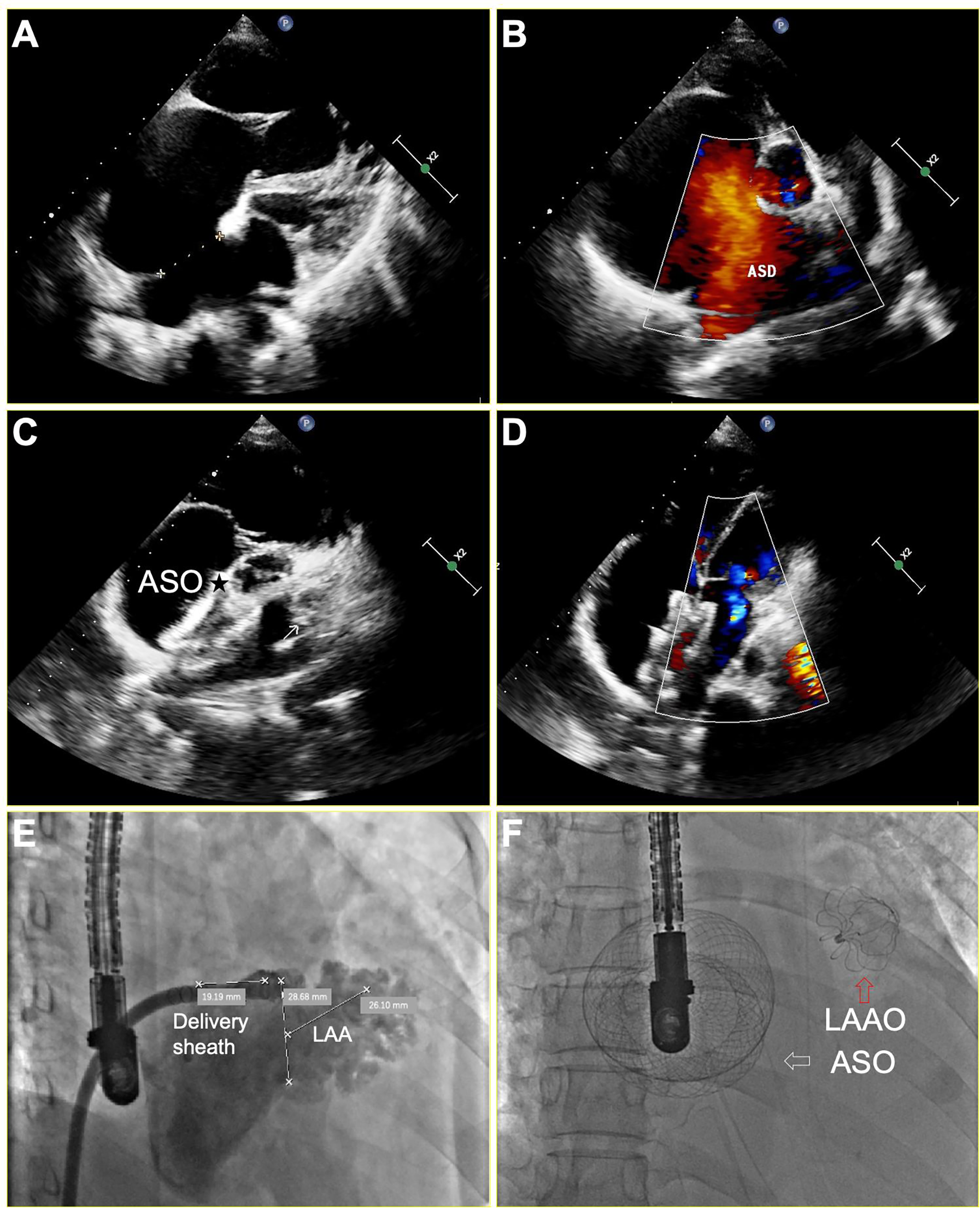 Panels A to D show echocardiography images detailing a heart in various stages of examination, highlighting an atrial septal defect (ASD) and an Amplatzer septal occluder (ASO). Panels E and F display x-ray images of a delivery sheath and a left atrial appendage occluder (LAAO), with labeled measurements and placements in the heart