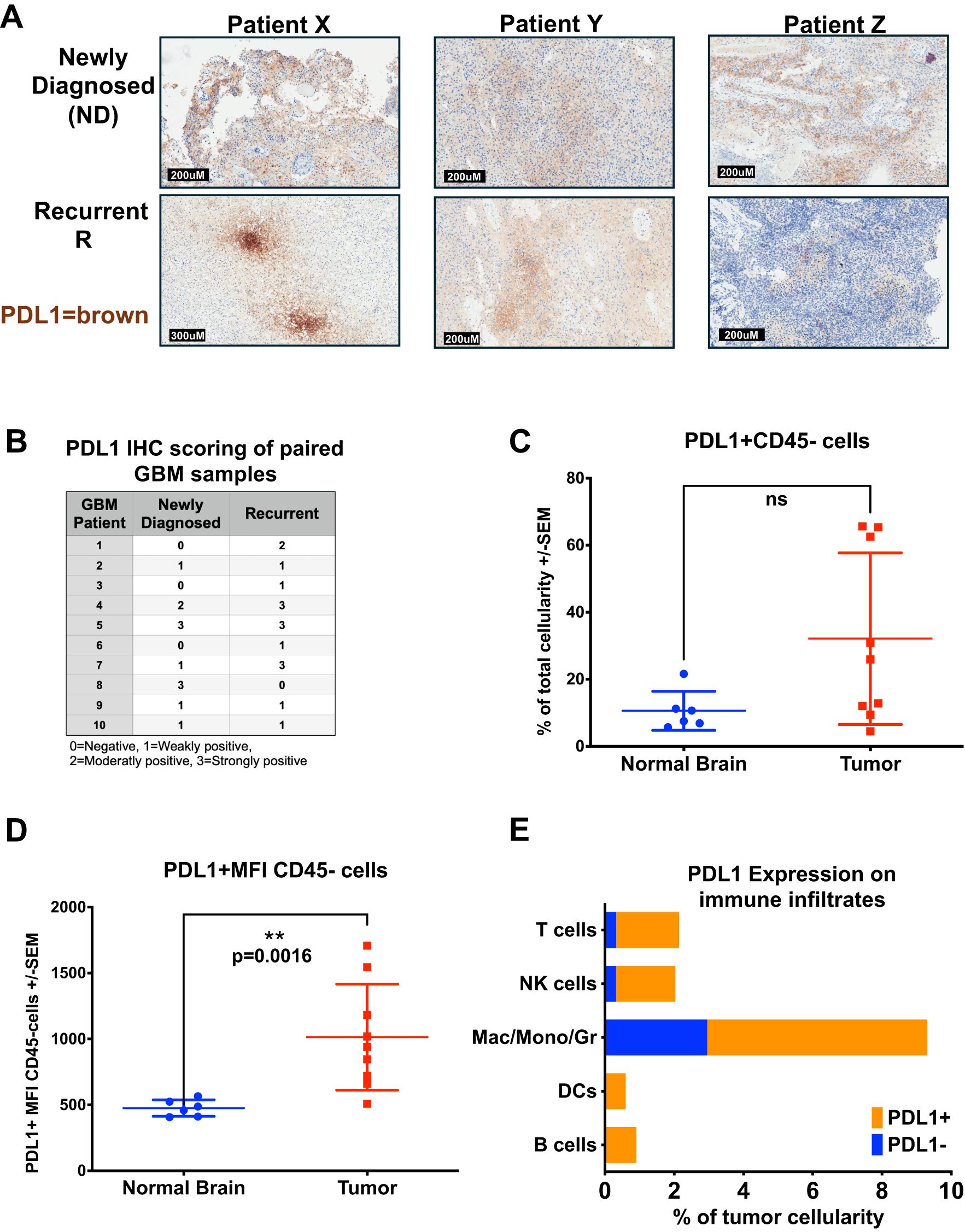 A multi-panel scientific figure displays various analyses related to PDL1 expression in glioblastoma samples. Panel A shows immunohistochemistry images of PDL1 staining in newly diagnosed and recurrent tumor samples from Patients X, Y, and Z. PDL1 presence is indicated by brown staining. Panel B presents a table with PDL1 IHC scoring for paired samples, ranging from negative to strongly positive. Panel C is a scatter plot comparing PDL1+CD45- cell percentages in normal brain versus tumor tissue. Panel D is a scatter plot showing PDL1+ mean fluorescence intensity in CD45- cells, indicating significant expression differences between normal brain and tumor. Panel E presents a bar chart of PDL1 expression on various immune infiltrates, with more expression in macrophages/monocytes/granulocytes.