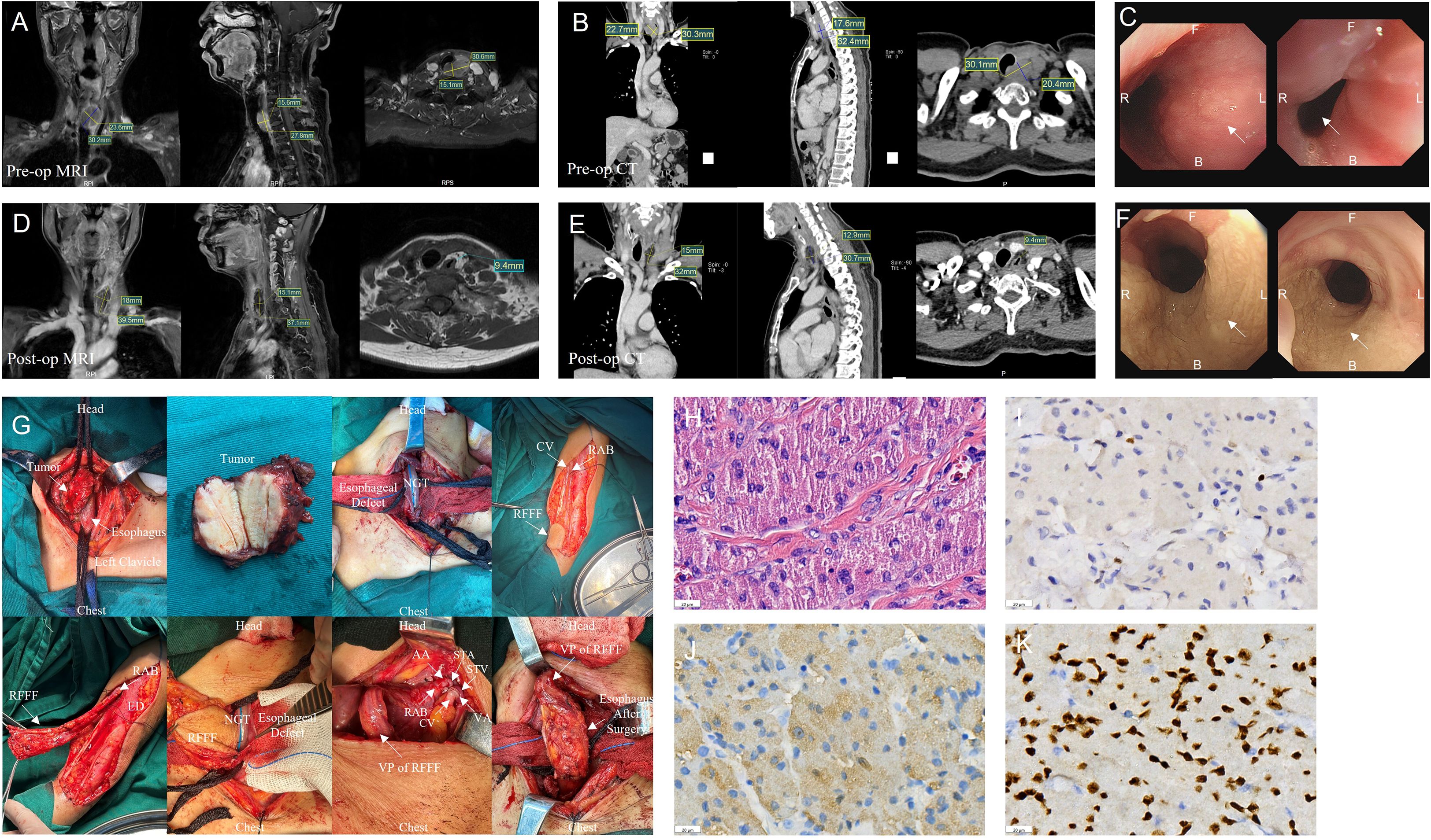 Multiple medical images and photographs are presented in a sequence. Panels A and D show pre-operative and post-operative MRI scans, highlighting changes in measurements. Panels B and E display pre-operative and post-operative CT scans, also comparing measurements. Panels C and F depict endoscopic views of the esophagus before and after surgery. Panel G includes surgical photos illustrating the tumor, esophageal defect, and various surgical procedures. The bottom-right images show histological samples labeled with letters H to K, displaying different tissue staining and cell structures for diagnosis.