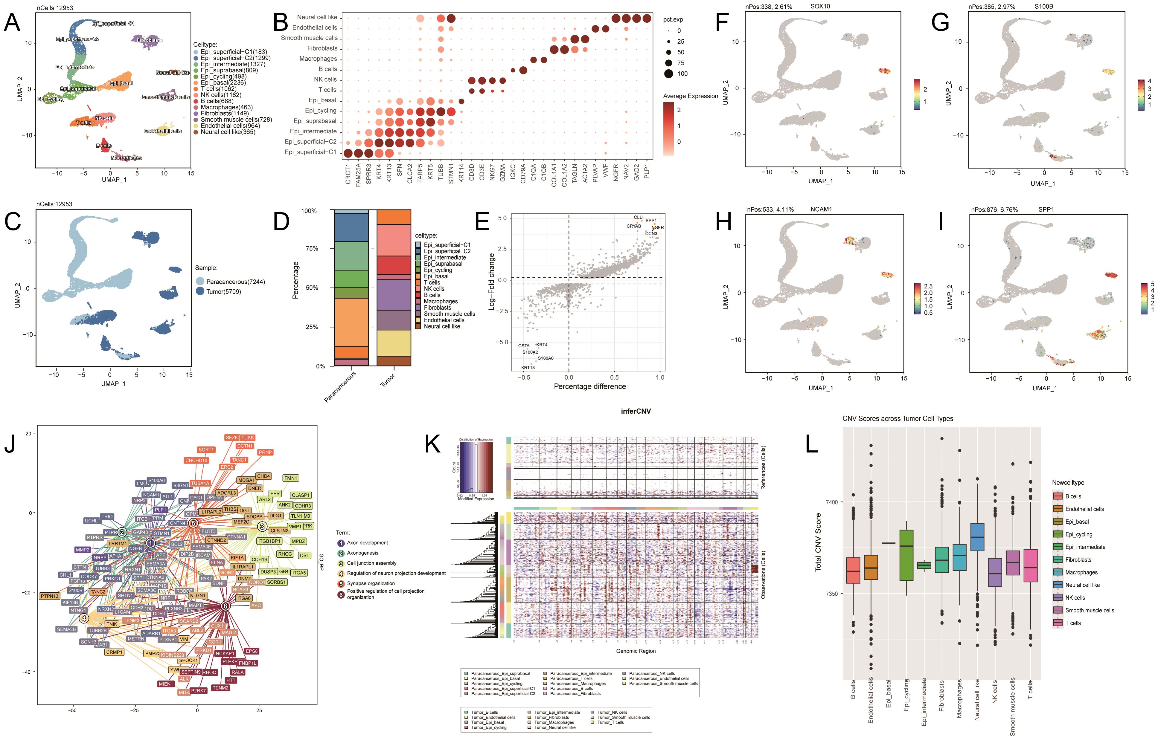 Panel A shows a UMAP plot with various cell types clustered by color. Panel B is a dot plot displaying gene expressions and proportions. Panel C is another UMAP plot colored by samples. Panel D is a bar graph showing cell type proportions in two samples. Panel E is a scatter plot with log fold change against percentage difference. Panels F, G, H, and I are UMAP plots highlighting specific genes among cells. Panel J is a network map of genes related to various processes. Panel K is an inferCNV heatmap of genomic regions across samples. Panel L is a boxplot of CNV scores across different tumor cell types.