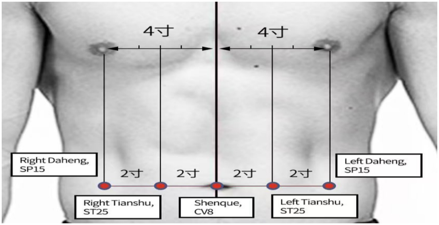 Diagram of acupuncture points on the human torso, showing Right Daheng (SP15), Right Tianshu (ST25), Shenque (CV8), Left Tianshu (ST25), and Left Daheng (SP15). Measurements indicate distances between points.