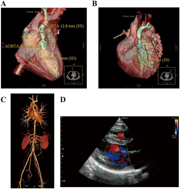 A: 3D heart scan showing the aorta with measurements 12.8 mm, 5.3 mm, and 6.9 mm. B: 3D heart scan with aorta measurement of 6.1 mm. C: 3D rendering of the cardiovascular system, including heart and connected vessels. D: Ultrasound image with color Doppler depicting blood flow.