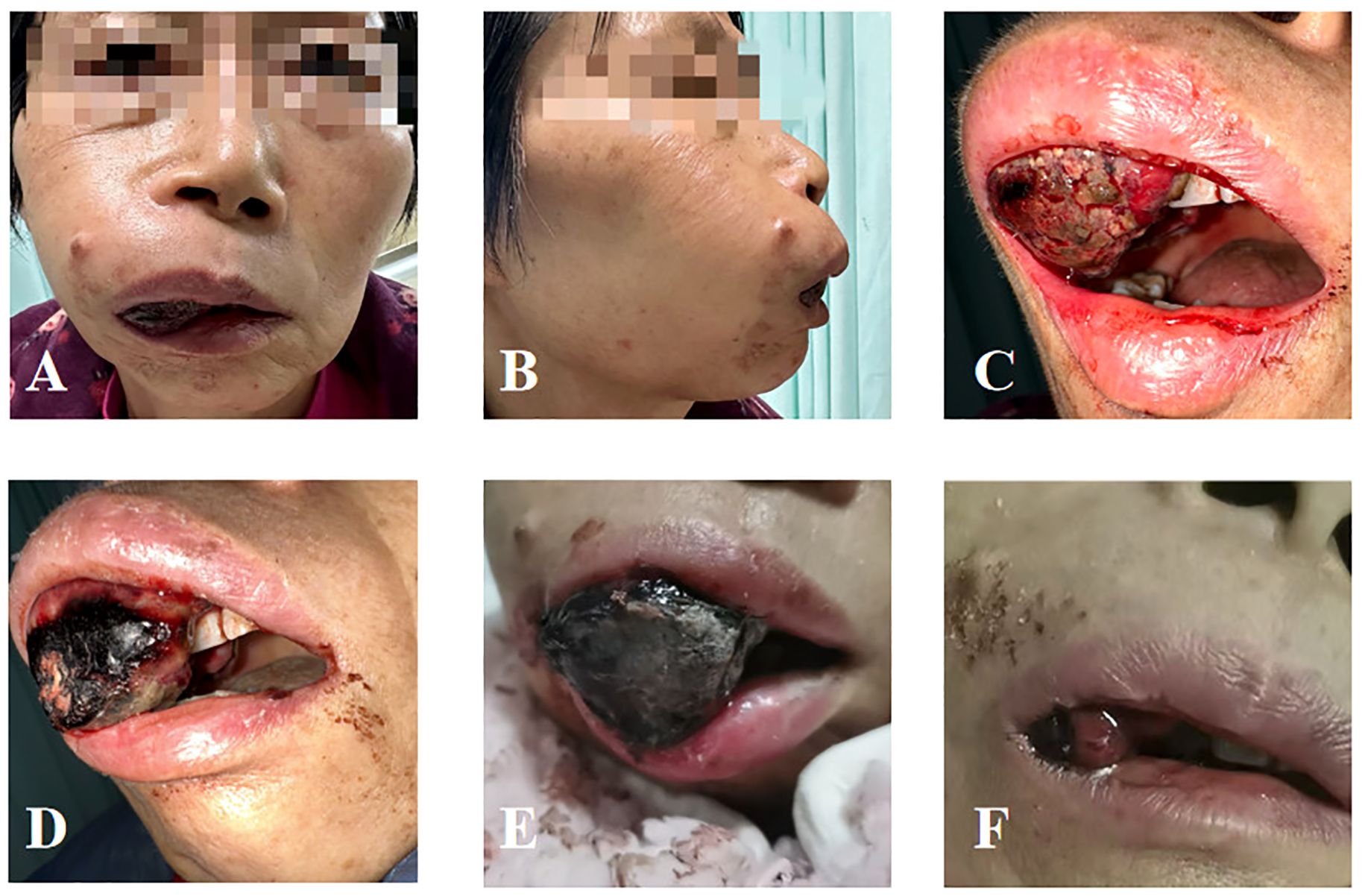 Six-panel image series showing a severe oral condition: A. Front view of a person's face with swelling and discoloration around the mouth. B. Side view highlighting a significant swelling on the cheek. C. Open mouth revealing a large, dark lesion on the inner lip. D. Close-up of another dark oral lesion with swelling. E. Focus on a similar dark lesion inside the mouth. F. Close-up of the mouth showing reduced swelling and healing. The images illustrate the progression and treatment of the oral condition.