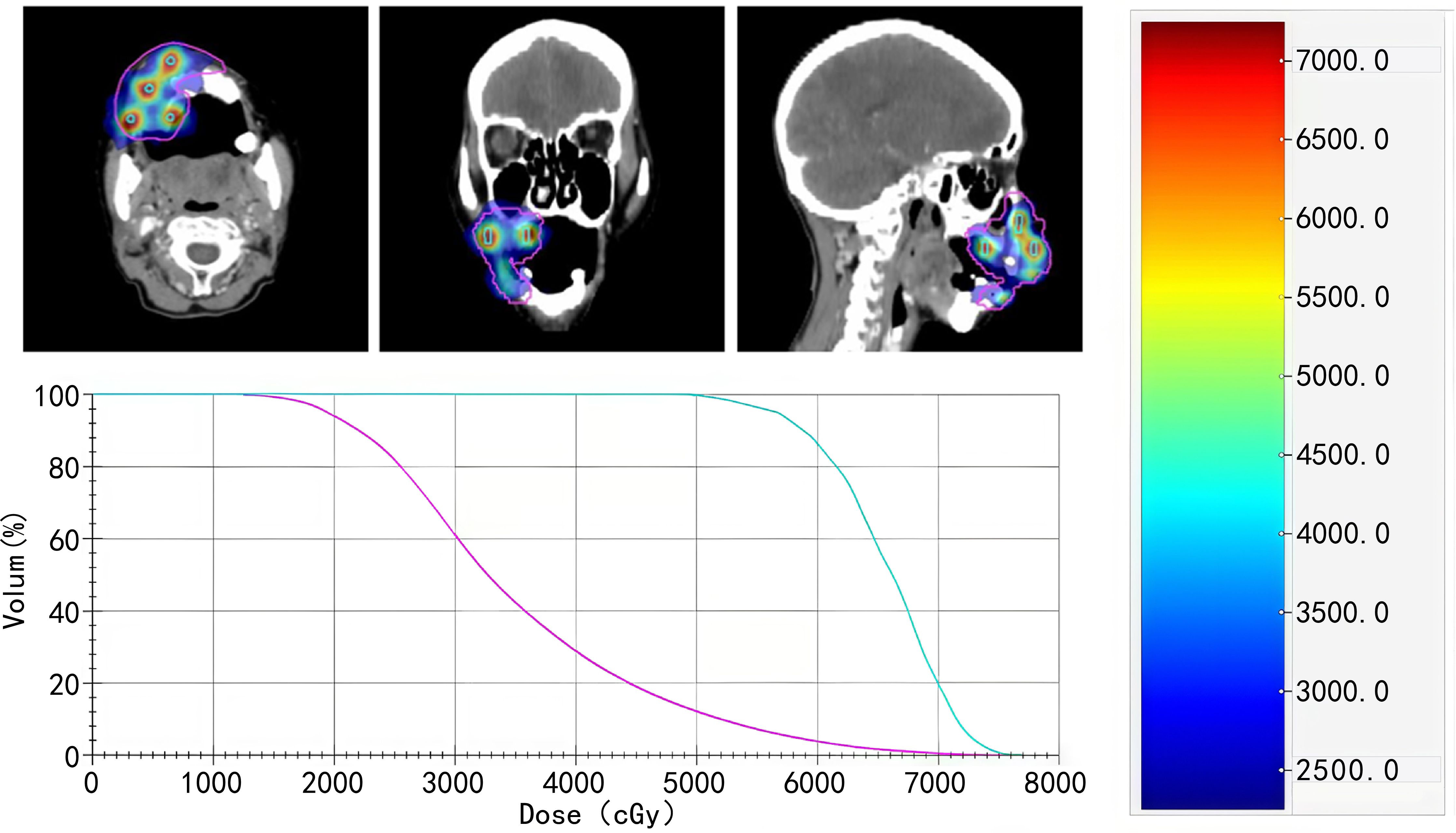 Medical imaging displays three CT scan cross-sections of a head with colored overlays indicating radiation dose distribution. A color scale ranging from blue to red represents increasing dose levels from 2500 to 7000 centigray. Below is a dose-volume histogram graph, showing volume percentages against dose in centigray, with two curves in blue and purple indicating varying dose distributions.