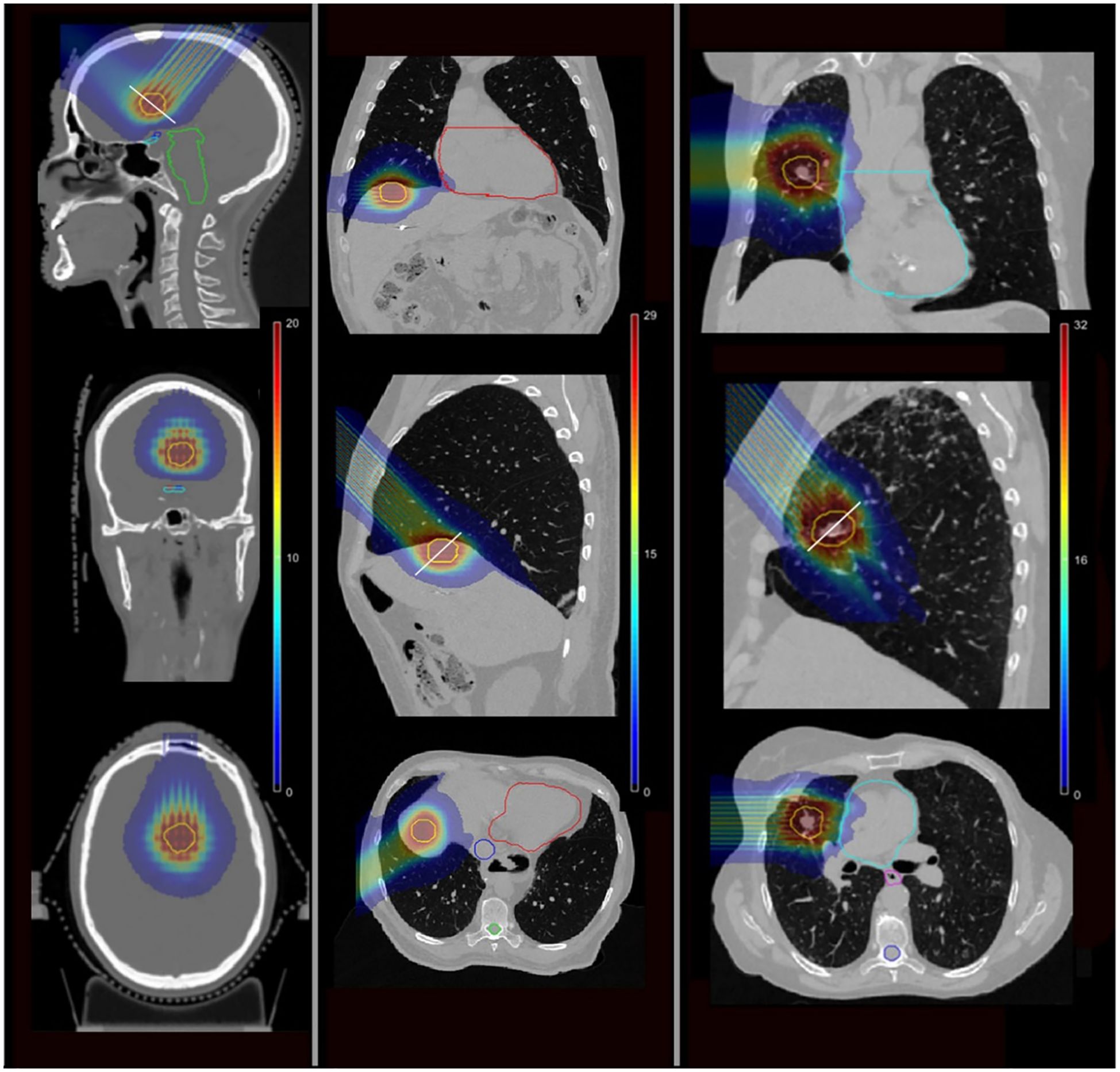 Composite image showing medical scans with radiation therapy overlays. The images display side, coronal, and axial views of the head and thorax. Color gradients indicate radiation intensity zones targeting specific areas within the scans, marked with contours and color codes.