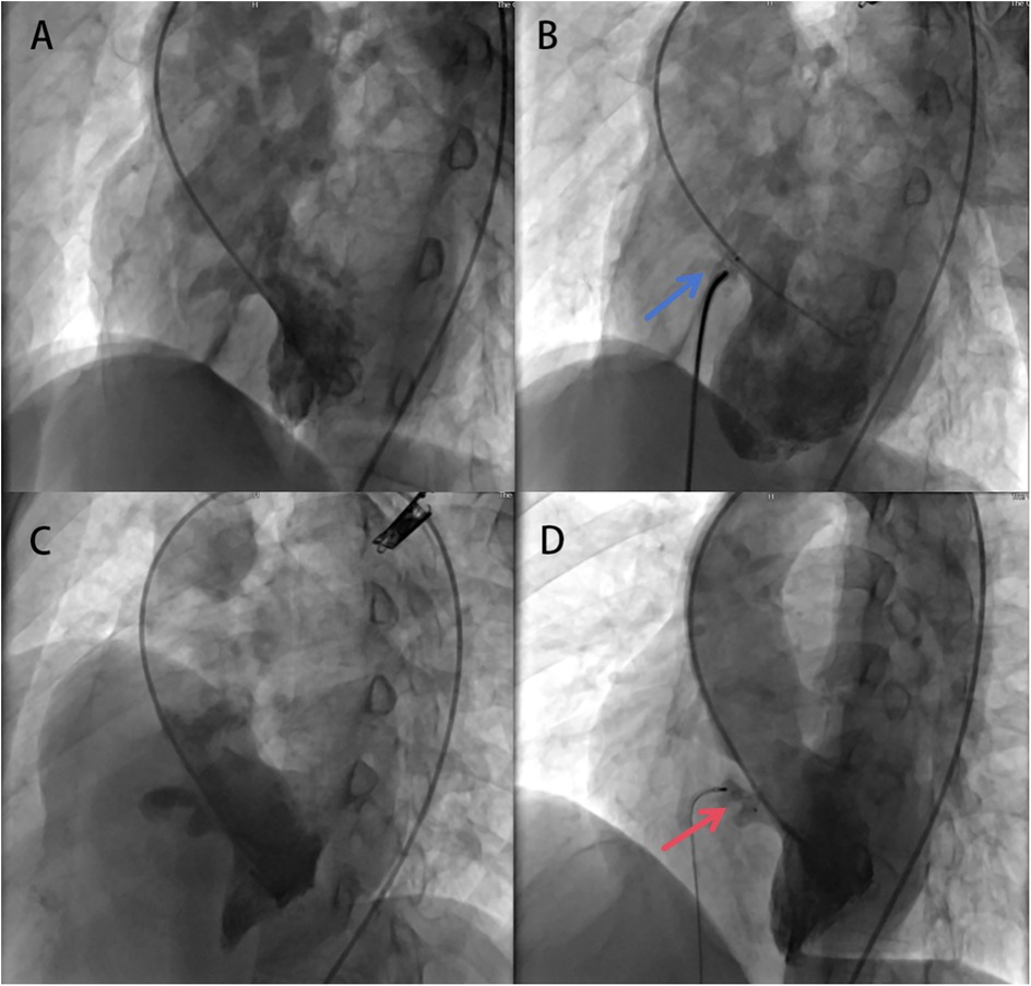 Fluoroscopic images A to D show catheter procedures in a blood vessel. Image A shows initial catheter positioning. Image B, marked with a blue arrow, indicates catheter insertion. Image C shows further progression. Image D, marked with a red arrow, depicts catheter contact with the vessel wall.