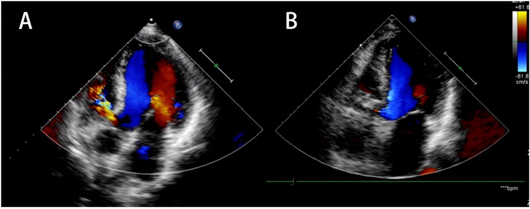Two panels of echocardiogram images labeled A and B. Panel A shows color Doppler flow mapping with regions of blue, red, and yellow indicating blood flow velocities within the heart. Panel B shows a similar Doppler flow pattern with a dominant blue region. A color scale on the right indicates velocity measurement ranging from negative 61.6 centimeters per second to positive 61.6 centimeters per second.