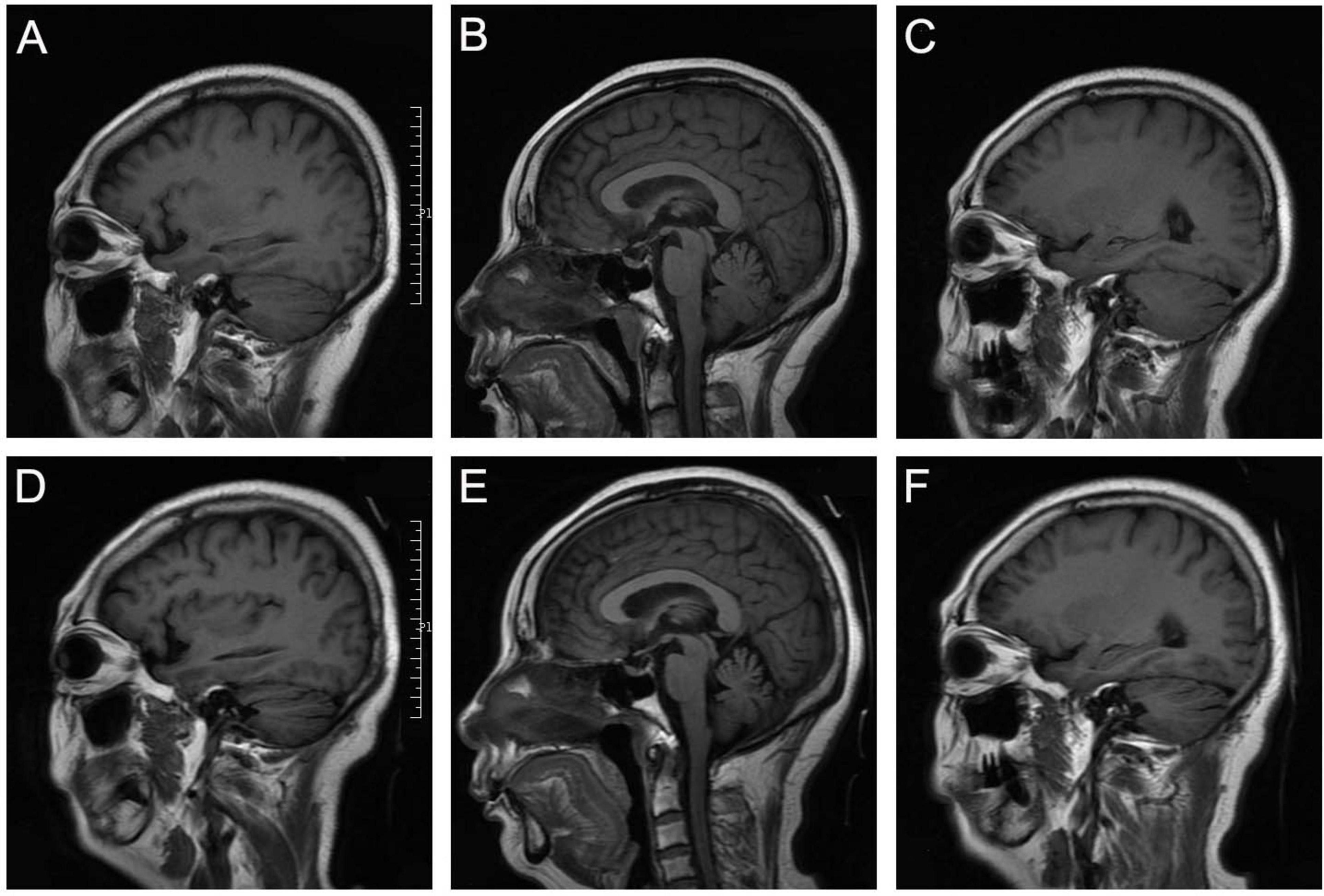 Six serial sagittal MRI scans (A-F) demonstrate progressive cerebellar atrophy from initial presentation (A-C) to follow-up (D-F), with varying contrast highlighting structural changes.