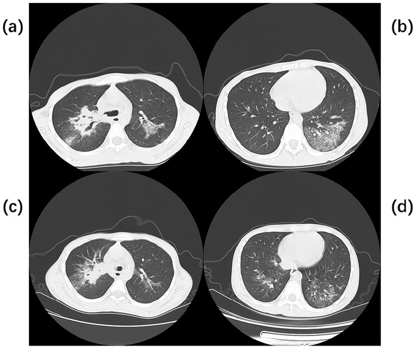 CT scans of lungs presented in four panels labeled (a), (b), (c), and (d). Panels (a) and (c) show lung images with notable markings suggestive of abnormalities. Panels (b) and (d) display clearer lung structures with some irregularities. Each panel highlights different sections of lung anatomy.