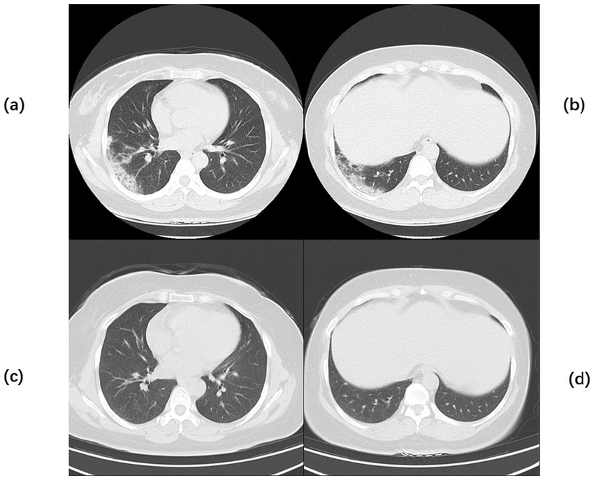 CT scans showing lung images. Panel (a) and (b) display scans with areas of opacity suggesting possible abnormalities. Panel (c) and (d) show clearer lung fields with minimal opacity.