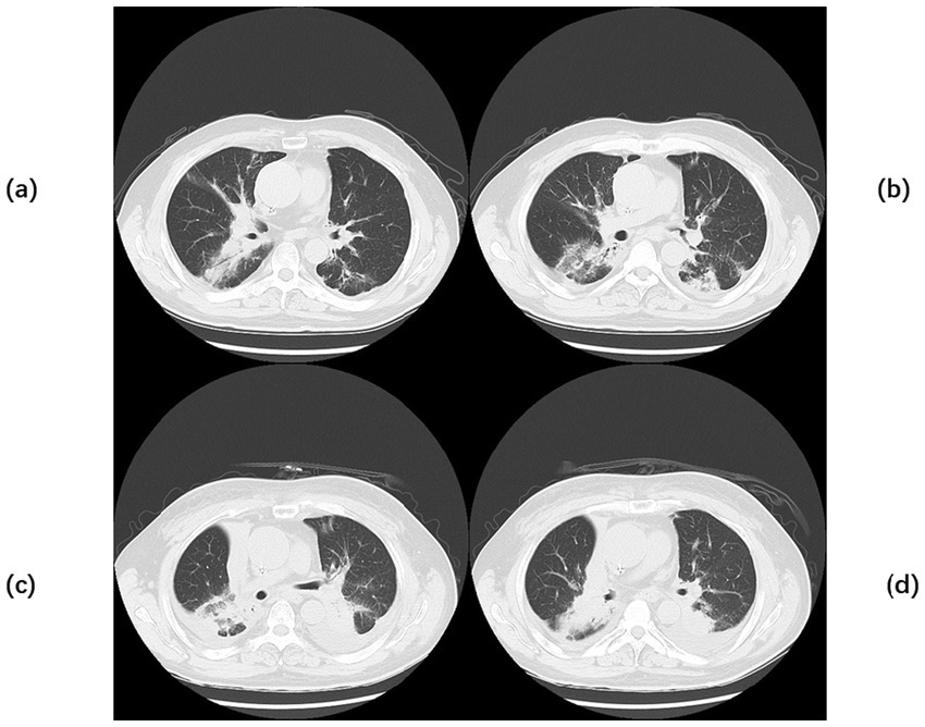 CT scans of lungs in four quadrants labeled (a) to (d). Each image shows varying levels of lung opacities and patterns, indicating possible abnormalities or disease presence. Panels illustrate different sections or time points.