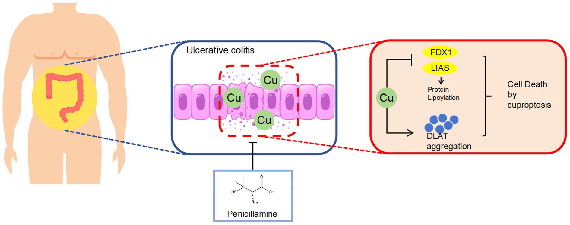 Diagram illustrating the process of cell death in ulcerative colitis. It shows copper (Cu) accumulation in cells, triggering protein lipoylation via FDX1 and LIAS, leading to DLAT aggregation and curoptosis. Penicillamine is shown as a treatment option.