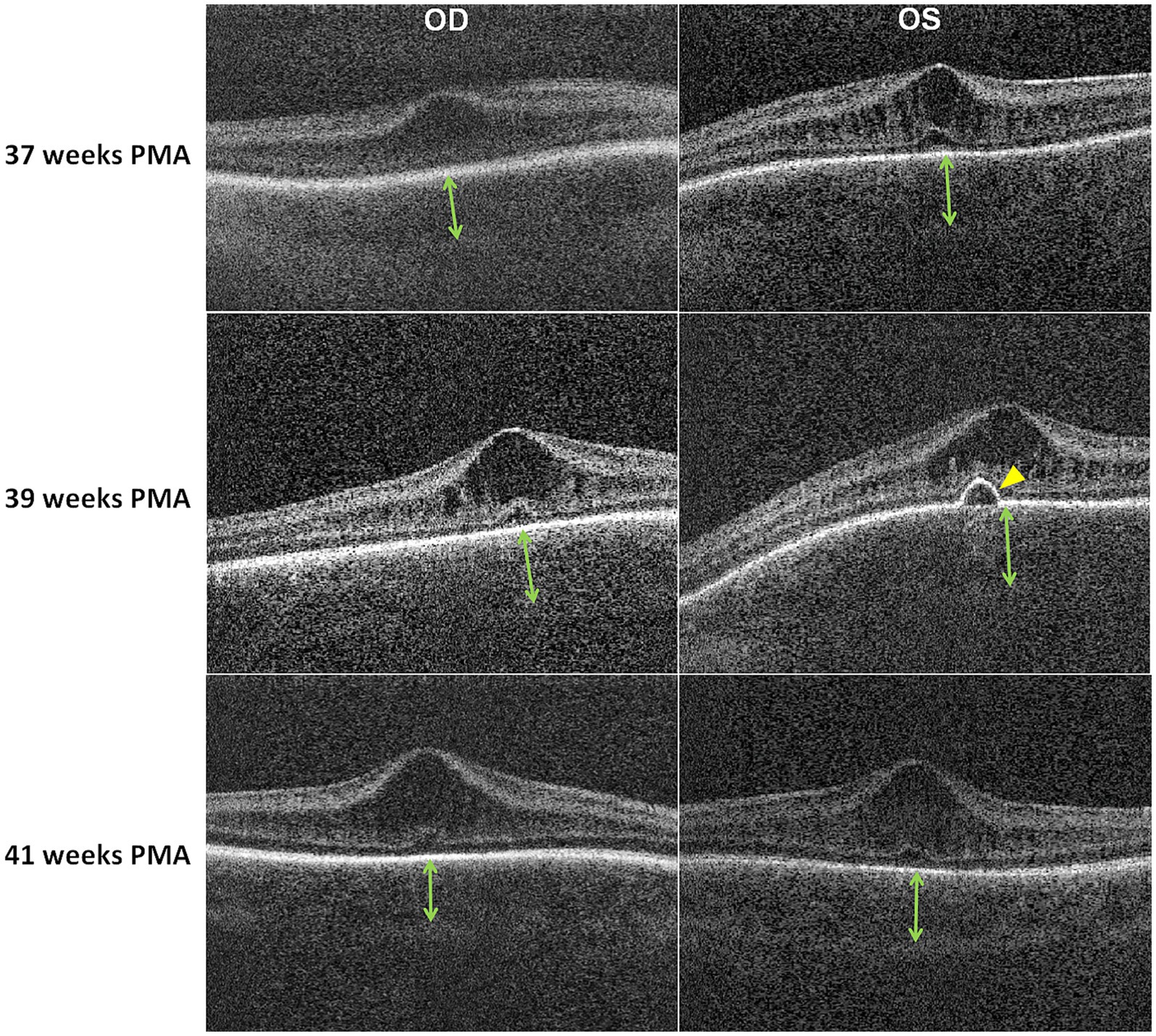 Optical coherence tomography images show retinal layers of both eyes at 37, 39, and 41 weeks postmenstrual age (PMA). OD and OS images display retinal changes over time, marked by arrows. A yellow arrowhead indicates a notable feature in the 39-week OS image.