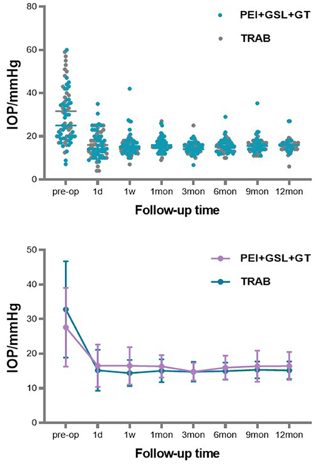 Two graphs showing intraocular pressure (IOP) in mmHg over time with two treatment groups: PEI+GSL+GT and TRAB. The top scatter plot shows individual IOP data points from pre-op to twelve months, with both groups experiencing a decrease over time. The bottom line graph depicts mean IOP trends for each group, with a noticeable drop immediately after the operation and stabilization thereafter. The PEI+GSL+GT group is marked in purple, while the TRAB group is in teal.