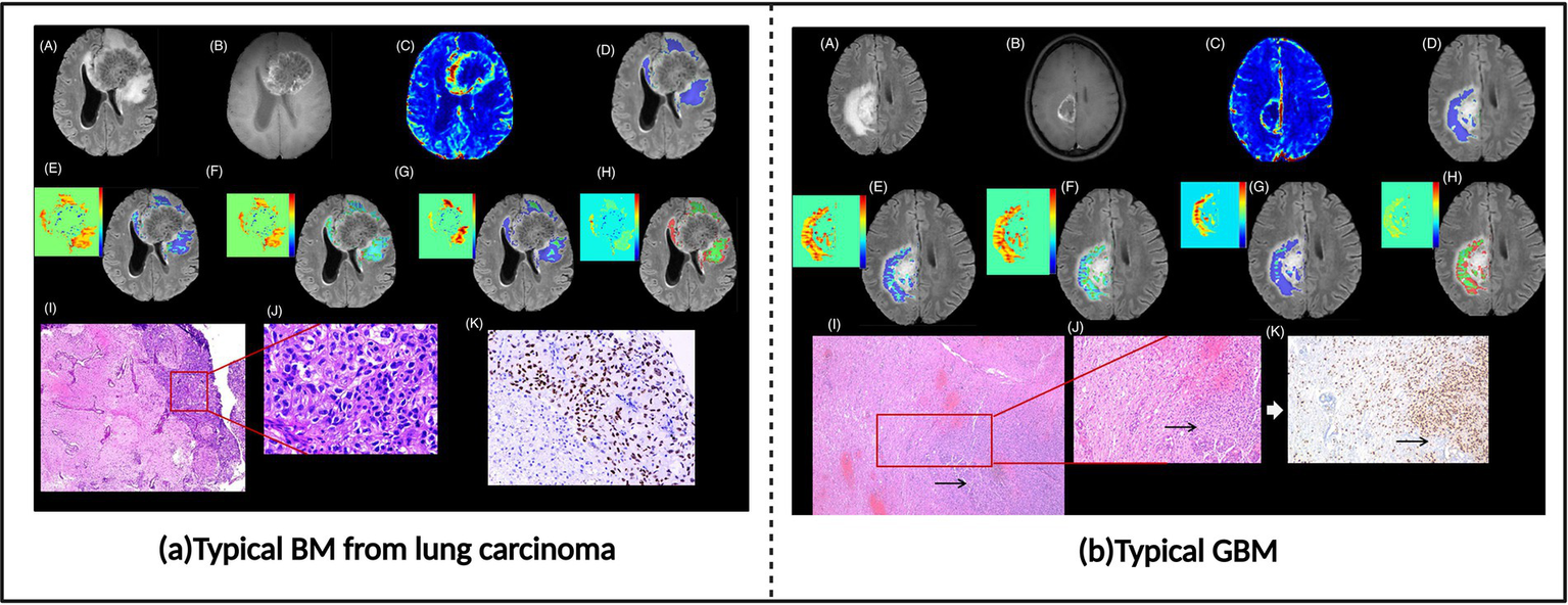 Brain scan images comparing typical brain metastasis from lung carcinoma and glioblastoma. On the left, images (A) to (H) depict various scan views and color maps for lung carcinoma, with histology slides (I) to (K) below. On the right, images (A) to (H) show glioblastoma scans with corresponding histology slides (I) to (K) below. Both sets highlight different regions and are accompanied by color-coded maps and microscopic tissue samples.