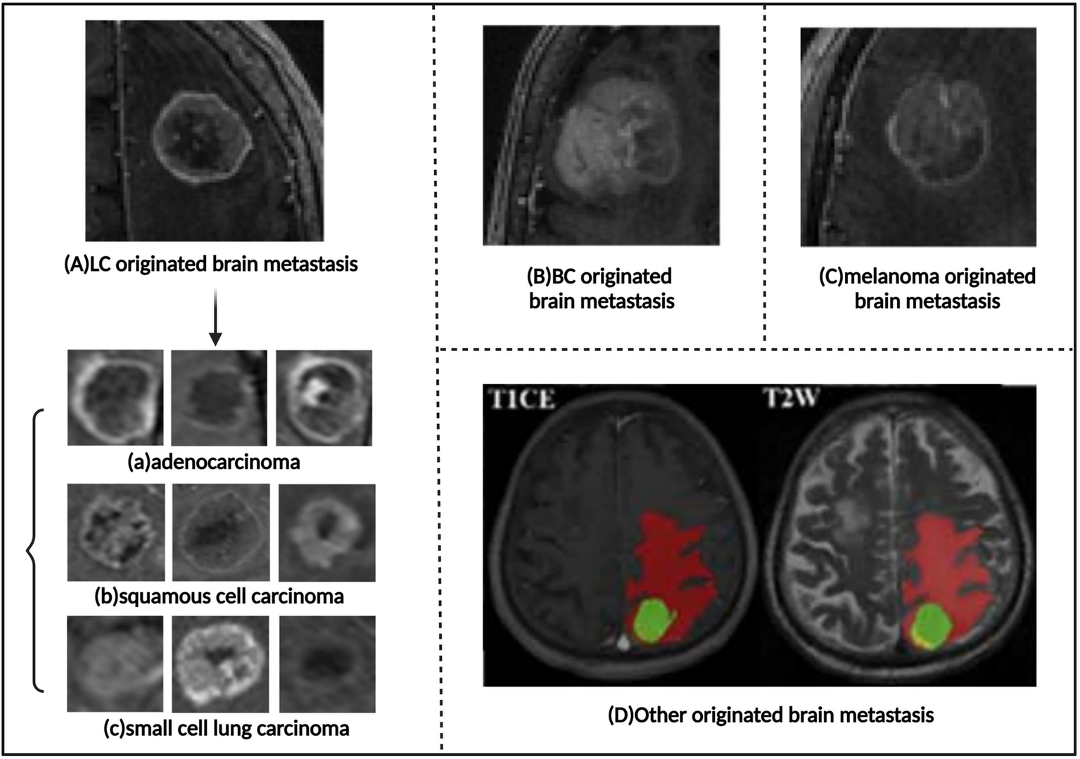 MRI images showing different types of brain metastases. Panel A depicts lung cancer origin, with subtypes: adenocarcinoma, squamous cell carcinoma, and small cell lung carcinoma. Panel B shows breast cancer origin. Panel C displays melanoma origin. Panel D presents other origins using T1 contrast-enhanced (T1CE) and T2-weighted (T2W) images with red and green highlighted areas.