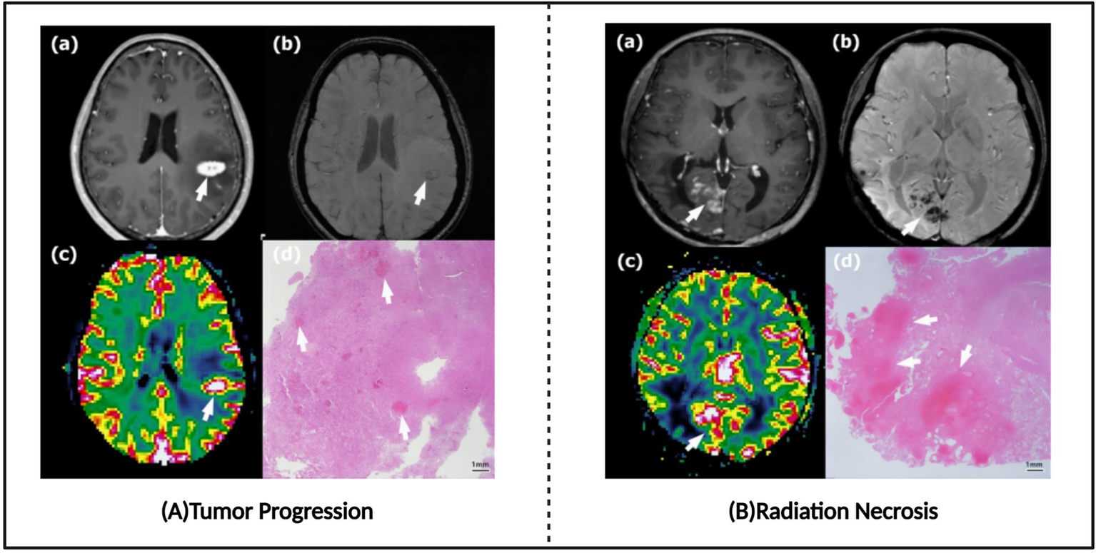 Two panels compare tumor progression and radiation necrosis using MRI scans. Panel A shows four images: (a) and (b) MRI scans with white arrows indicating a lesion, (c) a color-coded perfusion map, and (d) a histological pink-stained section. Panel B similarly presents (a) and (b) MRI scans with arrows, (c) a color-coded perfusion map, and (d) a pink-stained histological section. Arrows indicate key areas in each image.