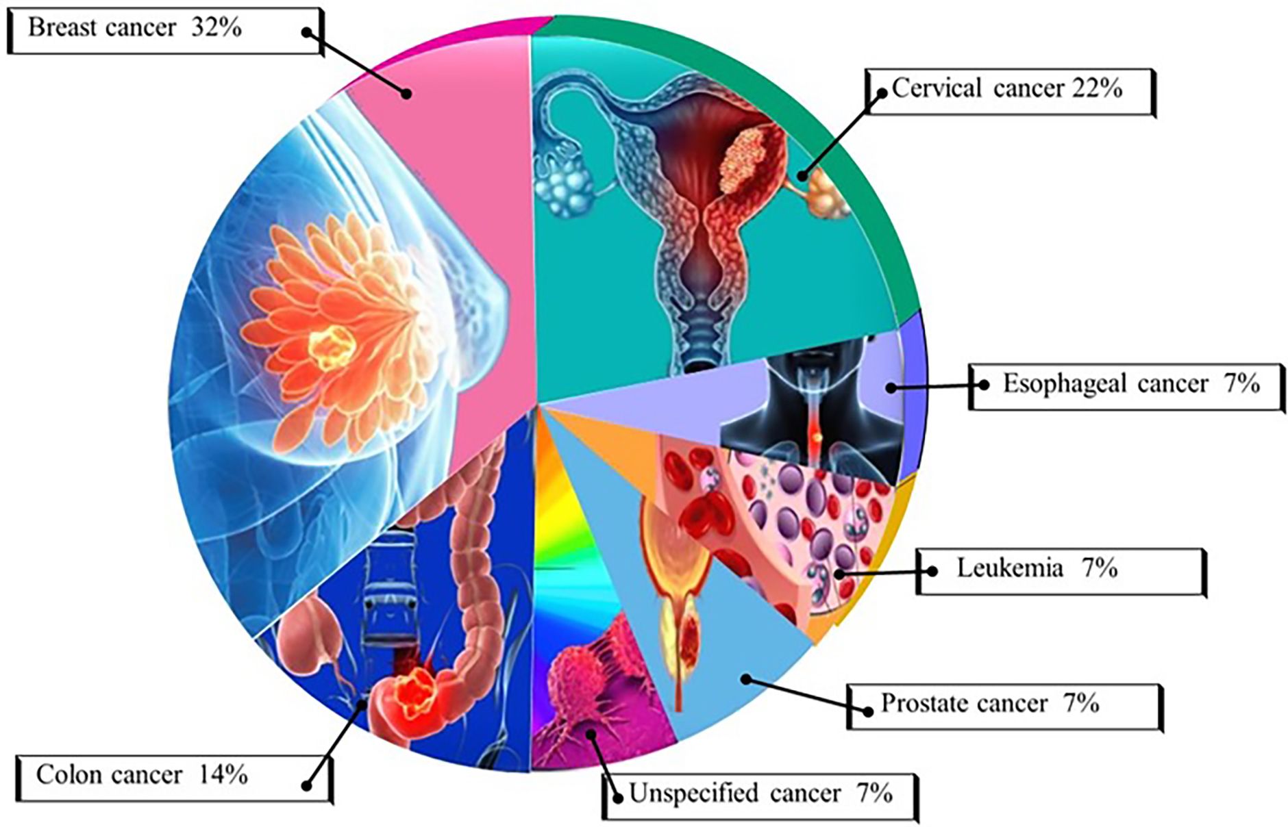 Pie chart depicting various cancer types with their respective percentages: breast cancer 32%, cervical cancer 22%, colon cancer 14%, esophageal cancer 7%, leukemia 7%, prostate cancer 7%, and unspecified cancer 7%. Each section is illustrated with related anatomical imagery.