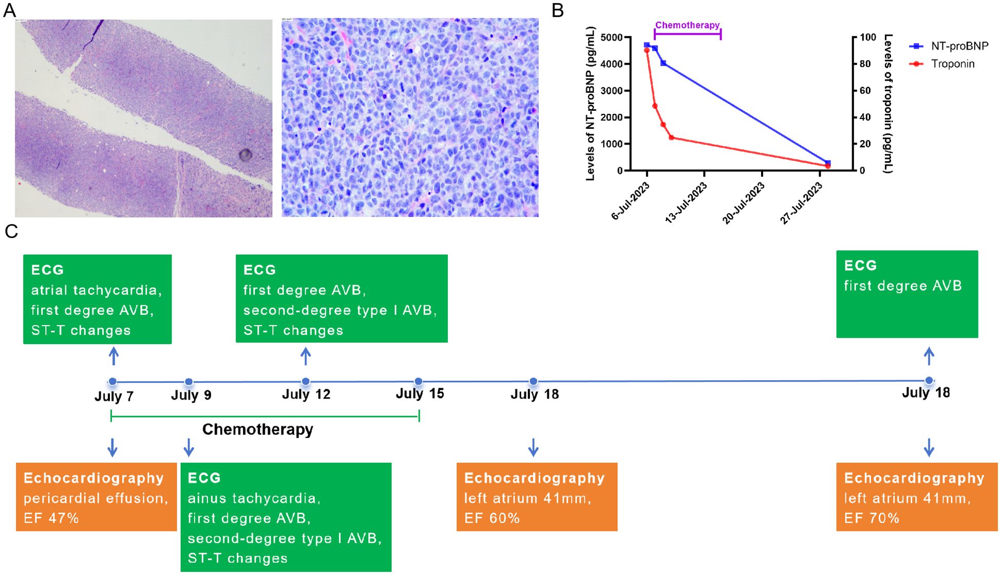 Histological and clinical presentation of a case: (A) Low magnification of histological slide. High magnification showing cellular detail. (B) Graph with NT-proBNP and Troponin levels reducing post-chemotherapy. (C) Timeline of events from April to July 29, showing ECG changes, echocardiography results, and treatments, including pericardiocentesis, thoracentesis, anti-TB treatment, biopsy, chemotherapy, and cardiac measurements (EF and atrial size).