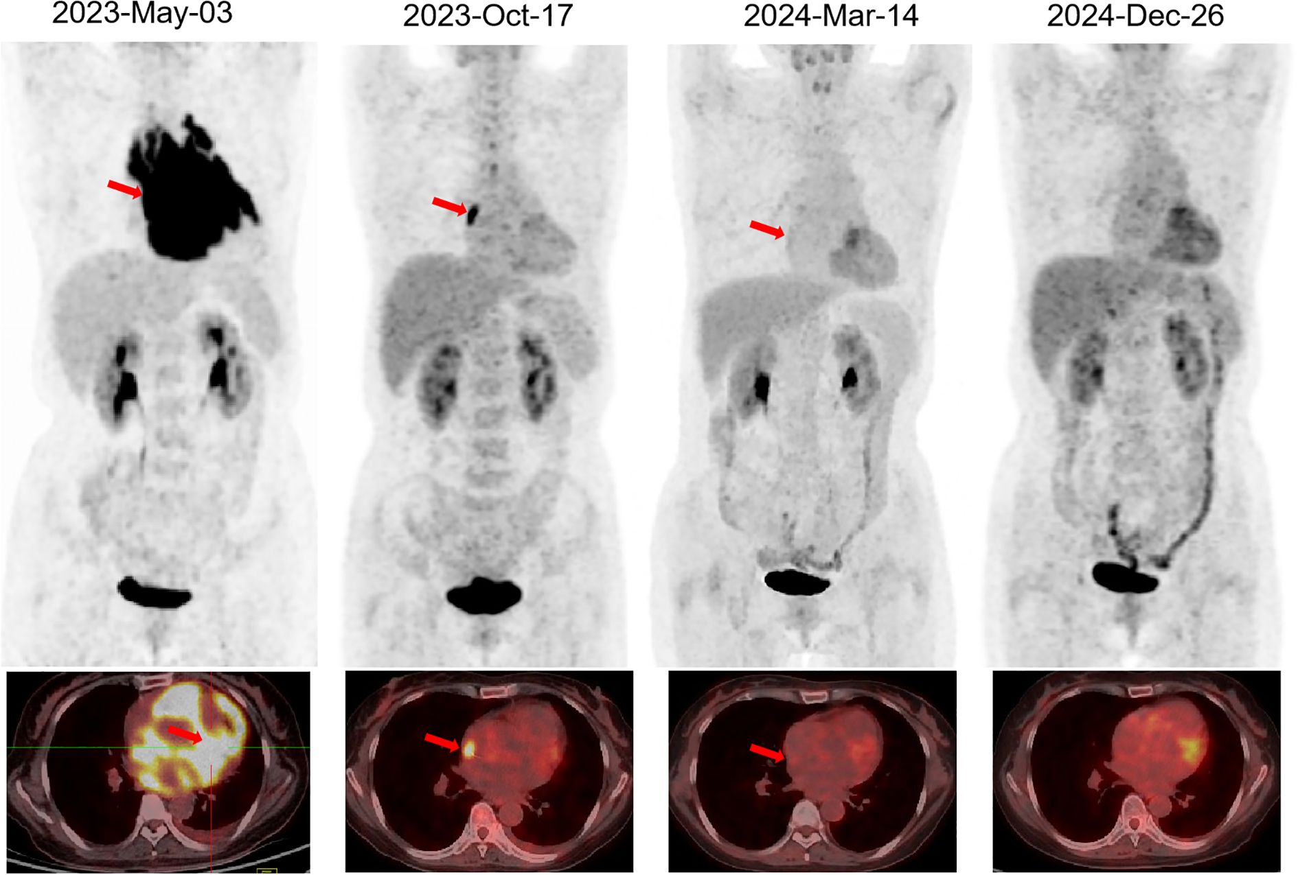 Four PET scans showing the progression of a tumor over time, dated May 3, 2023, October 17, 2023, March 14, 2024, and December 26, 2024. Red arrows indicate the tumor in each scan, highlighting changes in size and appearance.