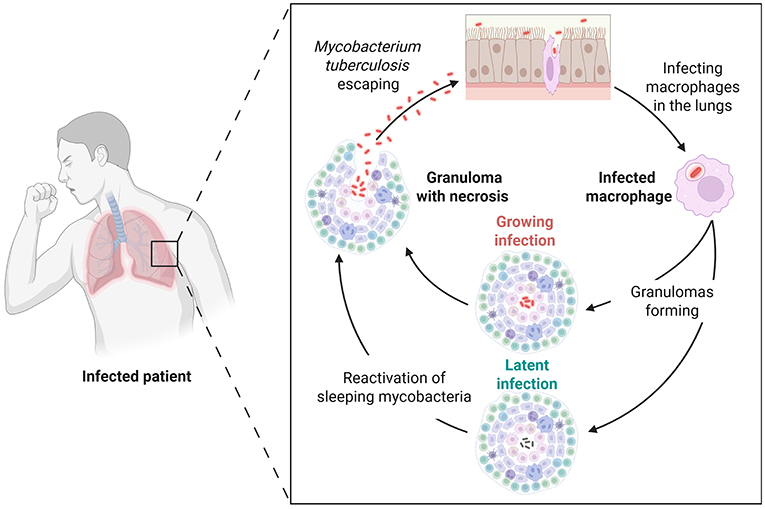 Diagram illustrating the tuberculosis infection process. An infected patient is shown with highlighted lungs. Mycobacterium tuberculosis infects lung macrophages, forming granulomas. These can remain latent or develop into necrotic granulomas as the bacteria escape, leading to growing infections. Reactivation of dormant bacteria can occur, continuing the cycle.