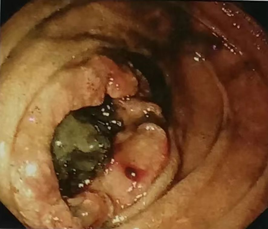 Endoscopic view of a section of the intestinal tract showing an ulcerated lesion with necrotic tissue and irregular, inflamed surfaces. The area is surrounded by normal intestinal tissue.