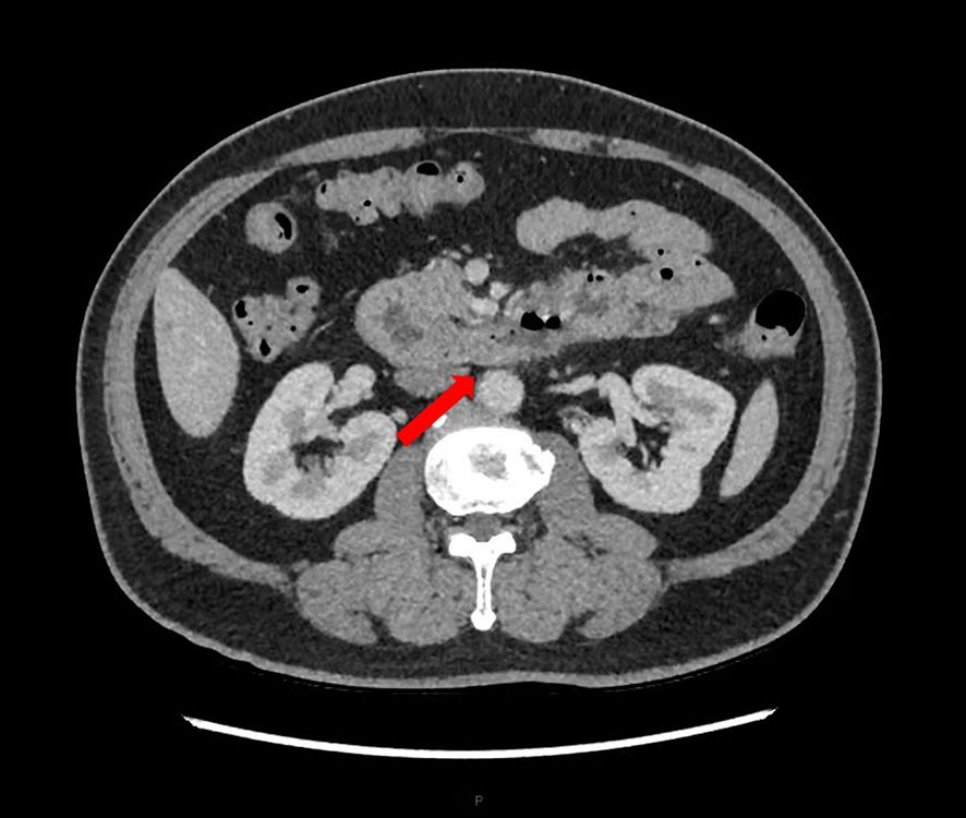 CT scan image showing a cross-sectional view of the abdomen. A red arrow indicates a specific area of interest or abnormality in the midsection, possibly around the intestines. The vertebral column and kidneys are visible.
