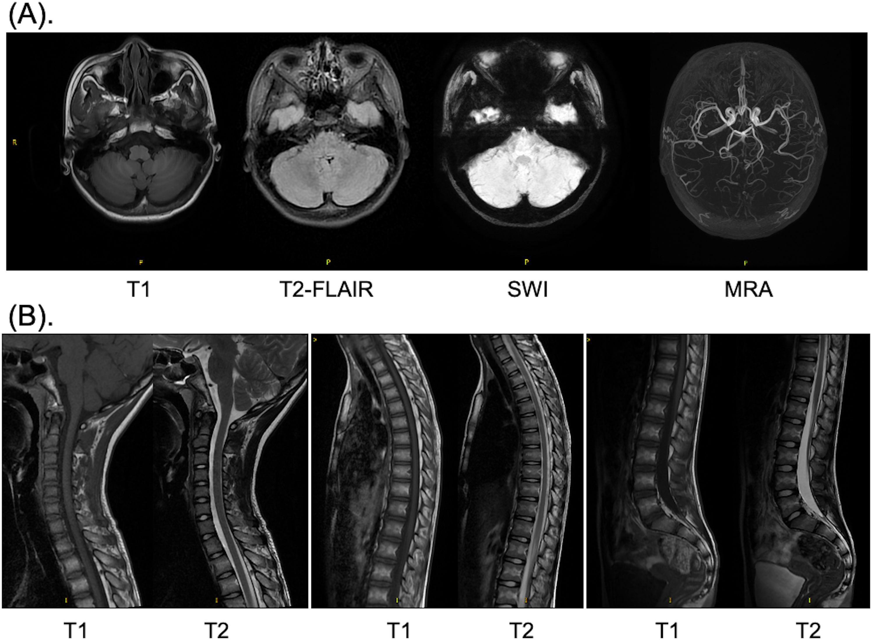 (A) Four MRI brain scans: T1, T2-FLAIR, SWI, and MRA, each highlighting different brain structures. (B) Six MRI spine scans: Cervical and thoracic regions shown in T1 and T2 sequences, illustrating spinal cord and vertebrae details.