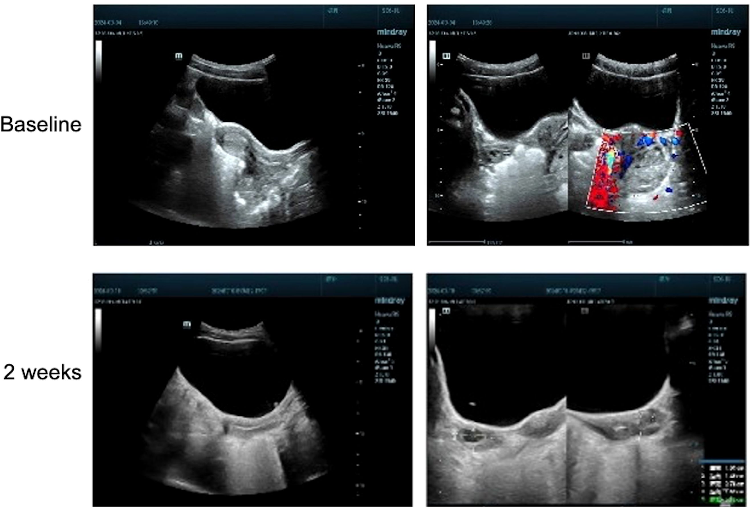 Ultrasound images showing two sets of scans labeled “Baseline” and “2 weeks”. The baseline images include a B-mode scan on the left and a color Doppler scan on the right, showing areas of blood flow. The “2 weeks” images similarly depict B-mode and Doppler scans, potentially indicating changes. The focus is on examining structural and blood flow variations over time.