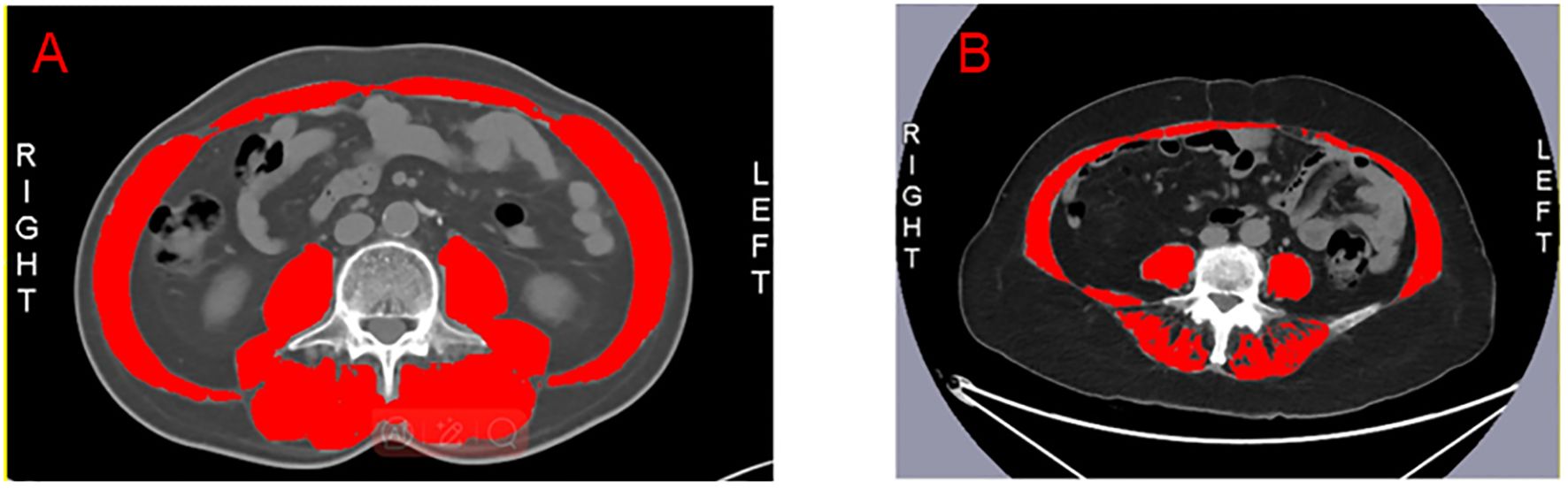 Two axial CT scan slices labeled A and B show abdominal cross-sections. Red highlights indicate areas of interest around the subcutaneous and visceral regions on both sides. Labeled “RIGHT” and “LEFT” for orientation.