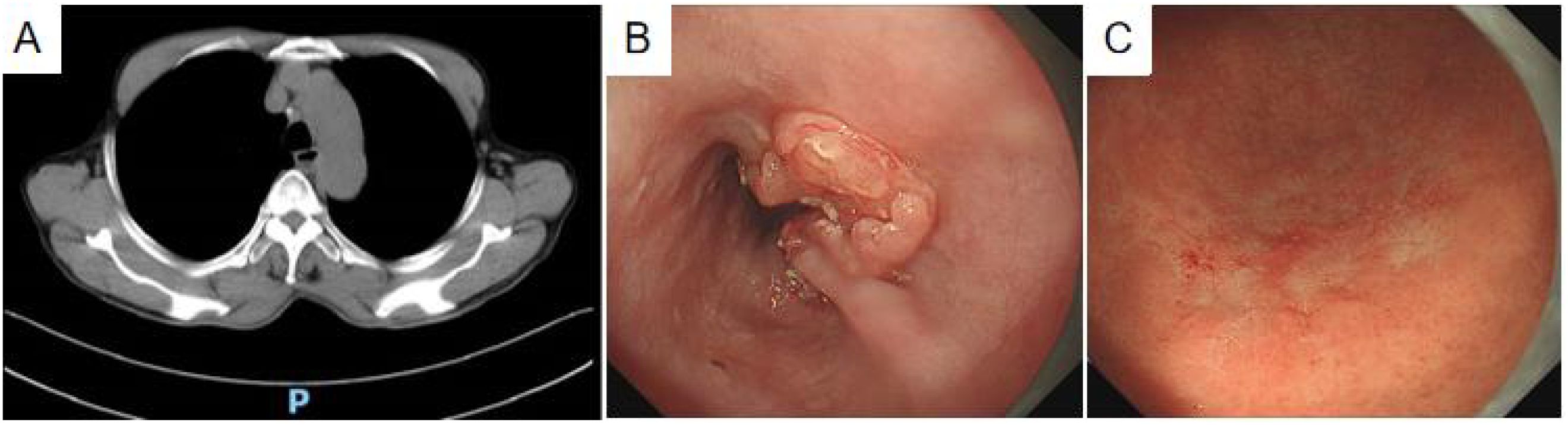 Panel A shows a CT scan of the thorax with clear visibility of ribs and spine. Panel B is an endoscopy image showing a red lesion in the esophagus. Panel C depicts the smooth, reddish lining of the esophagus with some inflammation.