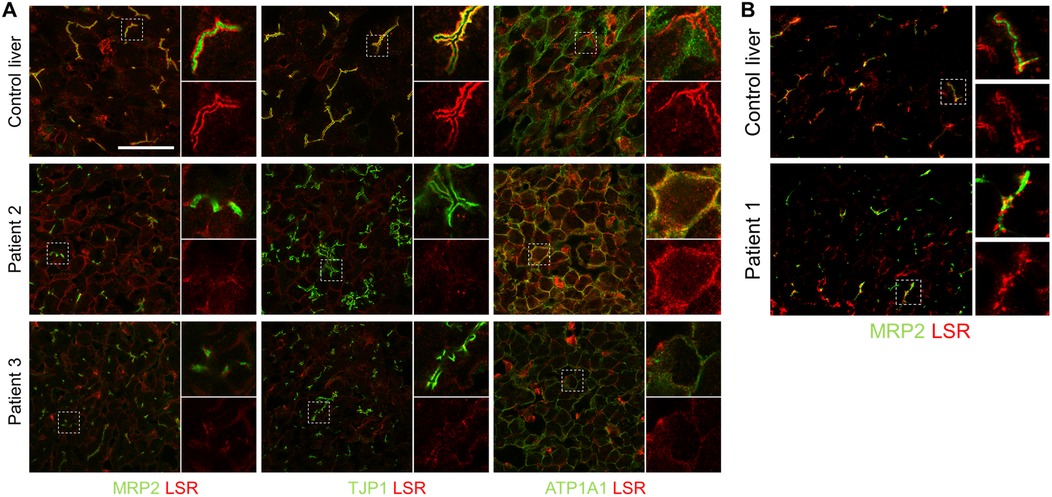 Confocal microscopy images displaying liver tissue sections from a control liver and patients. Panel A shows MRP2, TJP1, and ATP1A1 proteins in green, and LSR in red. Panel B compares MRP2 and LSR co-localization. Each section includes zoomed views of specific areas highlighted by dashed boxes, showing protein expression and localization differences between control and patient samples.