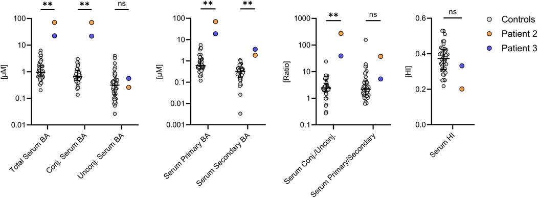 Dot plot graph comparing serum bile acid (BA) levels and ratios among controls and two patients, with results for total, conjugated, unconjugated, primary, and secondary BAs. Controls are represented by gray circles, Patient 2 by orange, and Patient 3 by blue. Axes are logarithmic, showing significant differences (indicated by two asterisks) and non-significant (ns) results for each group.