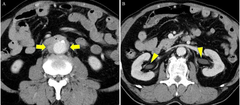 Two CT scan images of the abdomen. The left image highlights an aortic aneurysm with yellow arrows pointing to it. The right image shows a kidney with a highlighted abnormality using yellow arrowheads.