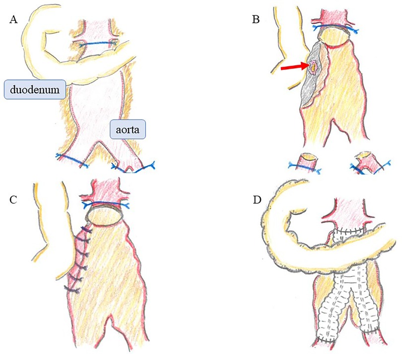 Illustration showing four labeled diagrams (A, B, C, D) of aorta-related procedures. A: Aorta and duodenum are labeled. B: A defect in the aorta is indicated by a red arrow. C: The aorta is closed with sutures. D: A graft is attached to the aorta.