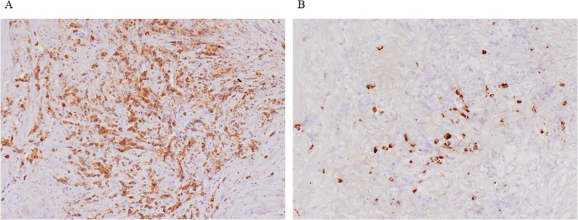 Histology slides labeled A and B show tissue samples with different degrees of staining. Image A displays a dense concentration of brown-stained cells, indicating a higher marker presence, whereas image B shows fewer stained cells, suggesting a lower marker presence. Both images highlight variations in cellular composition.