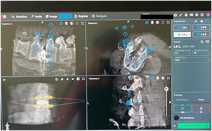 CT scan display showing multiple spinal views with marked trajectories in blue overlaid. The right panel shows details for \