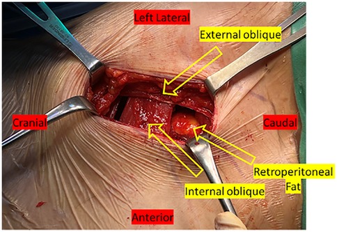 Surgical image showing an abdominal incision held open by retractors. Labels indicate anatomical positions and structures: \