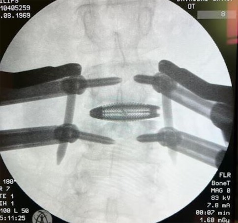 X-ray image showing surgical tools and an implanted device within the spinal region.