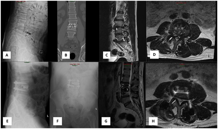 Composite medical image showing spinal scans. Panel A: Lateral x-ray of the lumbar spine. Panel B: Frontal CT scan highlighting vertebrae. Panel C: Sagittal MRI showing thoracic vertebrae detail. Panel D: Axial MRI with spinal canal view. Panels E and F: Post-operative lateral and anteroposterior x-rays with visible spinal hardware. Panel G: Post-operative sagittal MRI showing alignment. Panel H: Post-operative axial MRI displaying vertebrae.