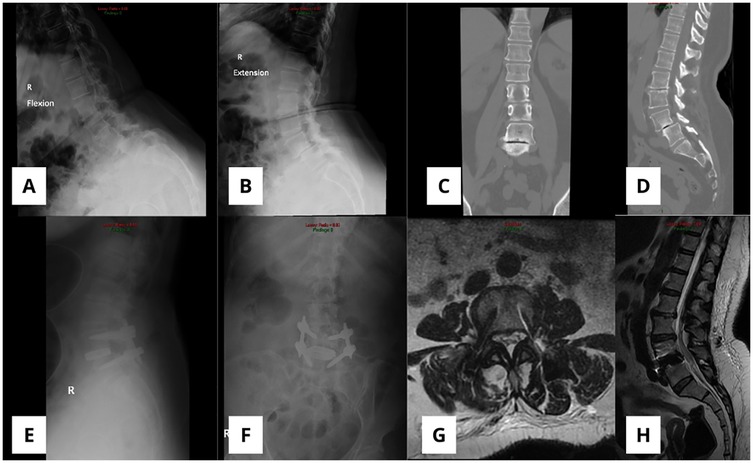 A series of eight spinal imaging scans labeled A to H. A and B show lateral x-rays with flexion and extension. C and D display coronal and sagittal CT scans. E and F present lateral and anterior x-rays post-surgery showing spinal hardware. G is an axial MRI showing vertebral structures. H is a sagittal MRI of the lumbar spine.