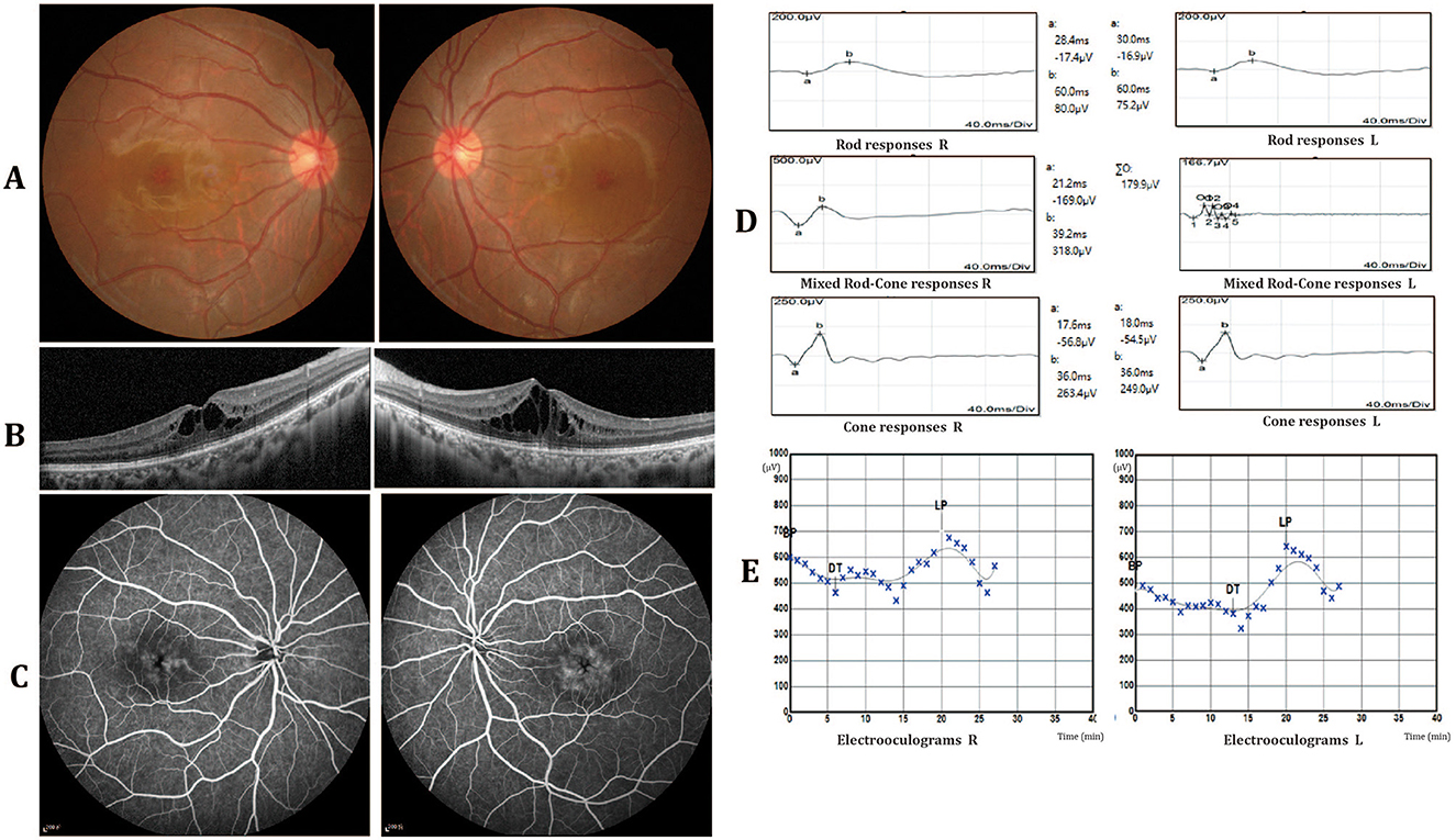 Panel A shows retinal images with visible optic discs and blood vessels. Panel B includes OCT scans illustrating retinal layers and elevation. Panel C displays angiographic images with detailed vascular patterns. Panel D presents graphs of rod, cone, and mixed rod-cone responses for both eyes, highlighting electrical activity. Panel E features electrooculogram graphs indicating eye movement responses over time.